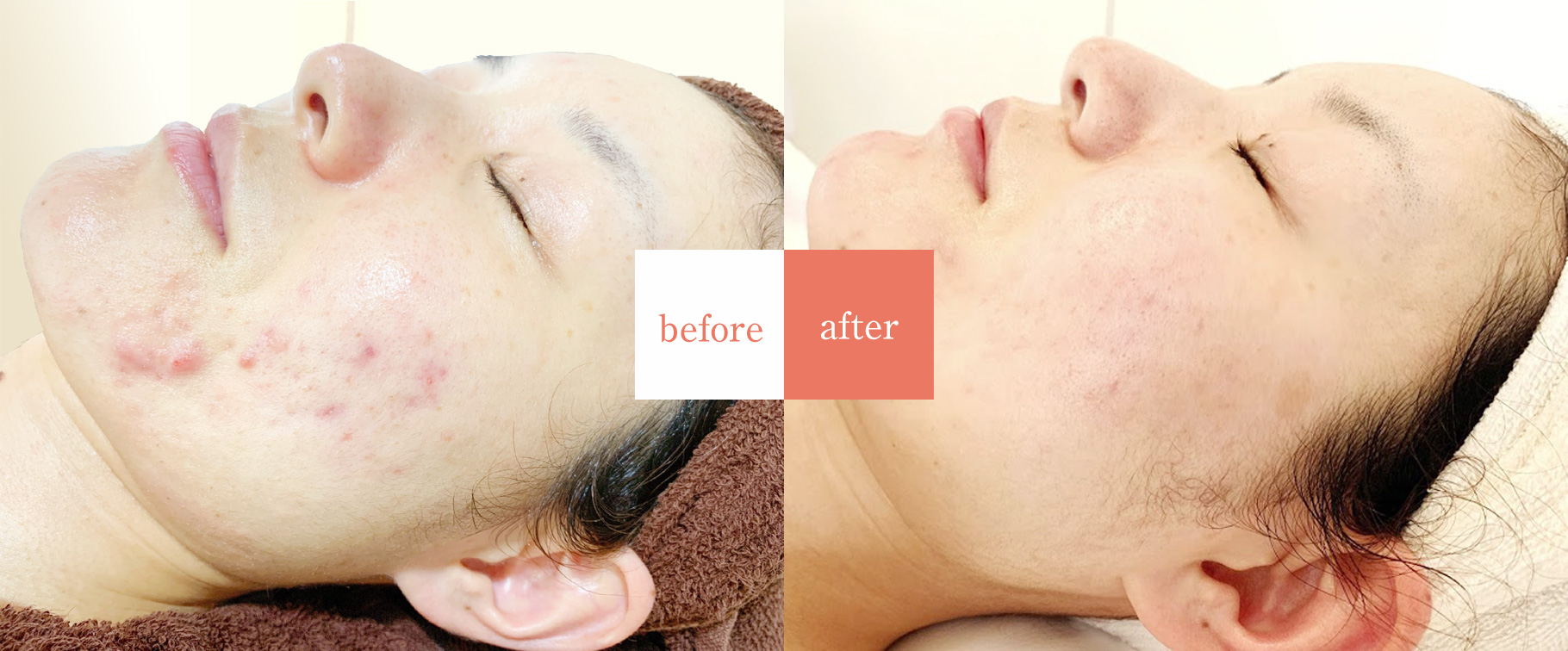 ニキビ・ニキビ跡専門エステサロン pecheAぺシュア 改善事例
