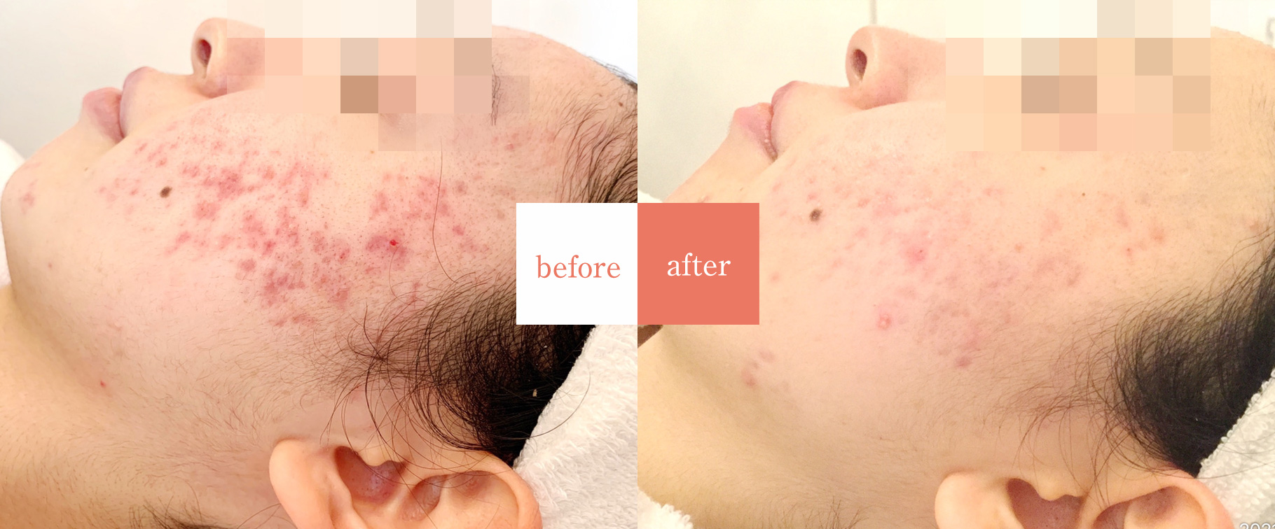 ニキビ・ニキビ跡専門エステサロン pecheAぺシュア 改善事例