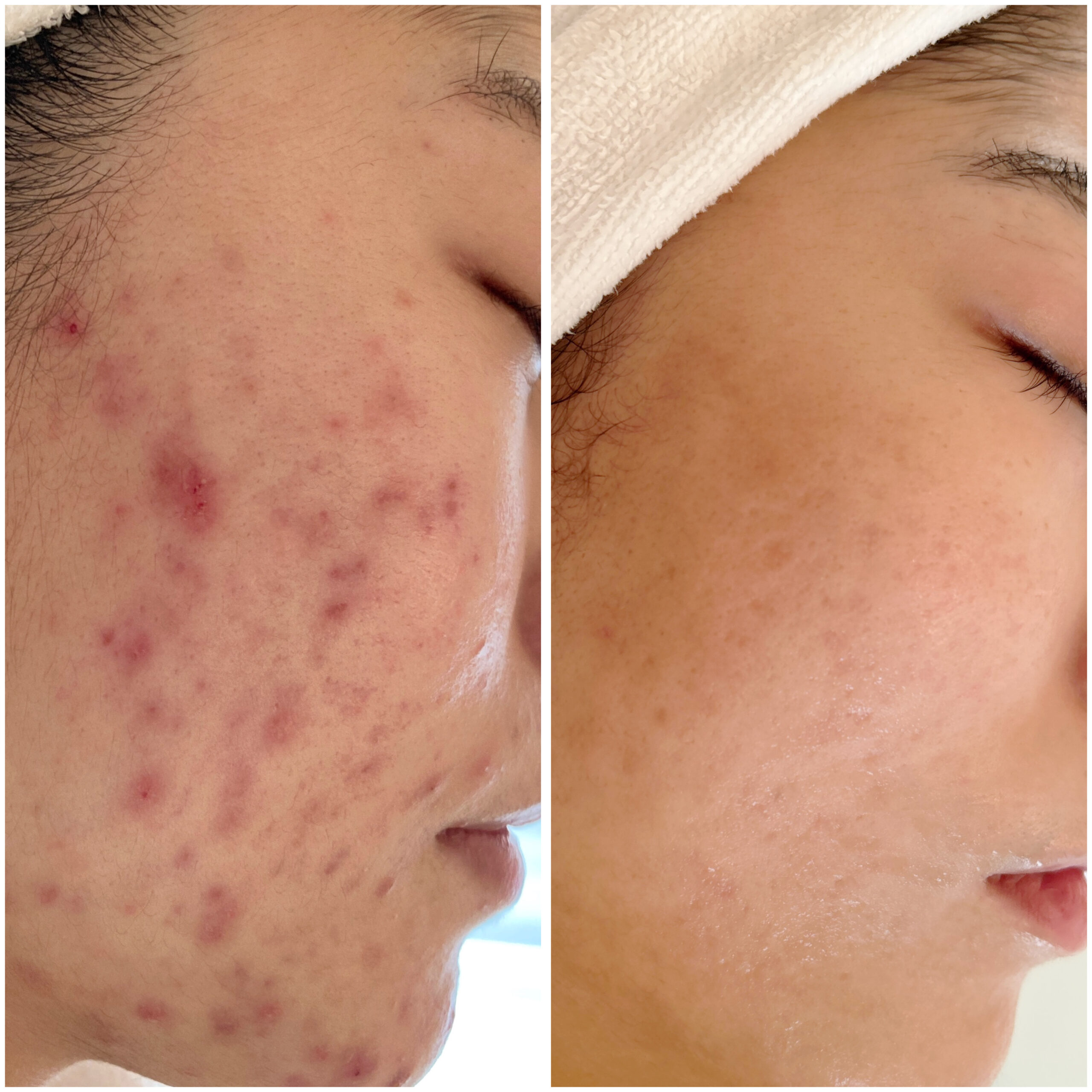 ニキビのかさぶた…剥がすと跡になる？正しい対処法