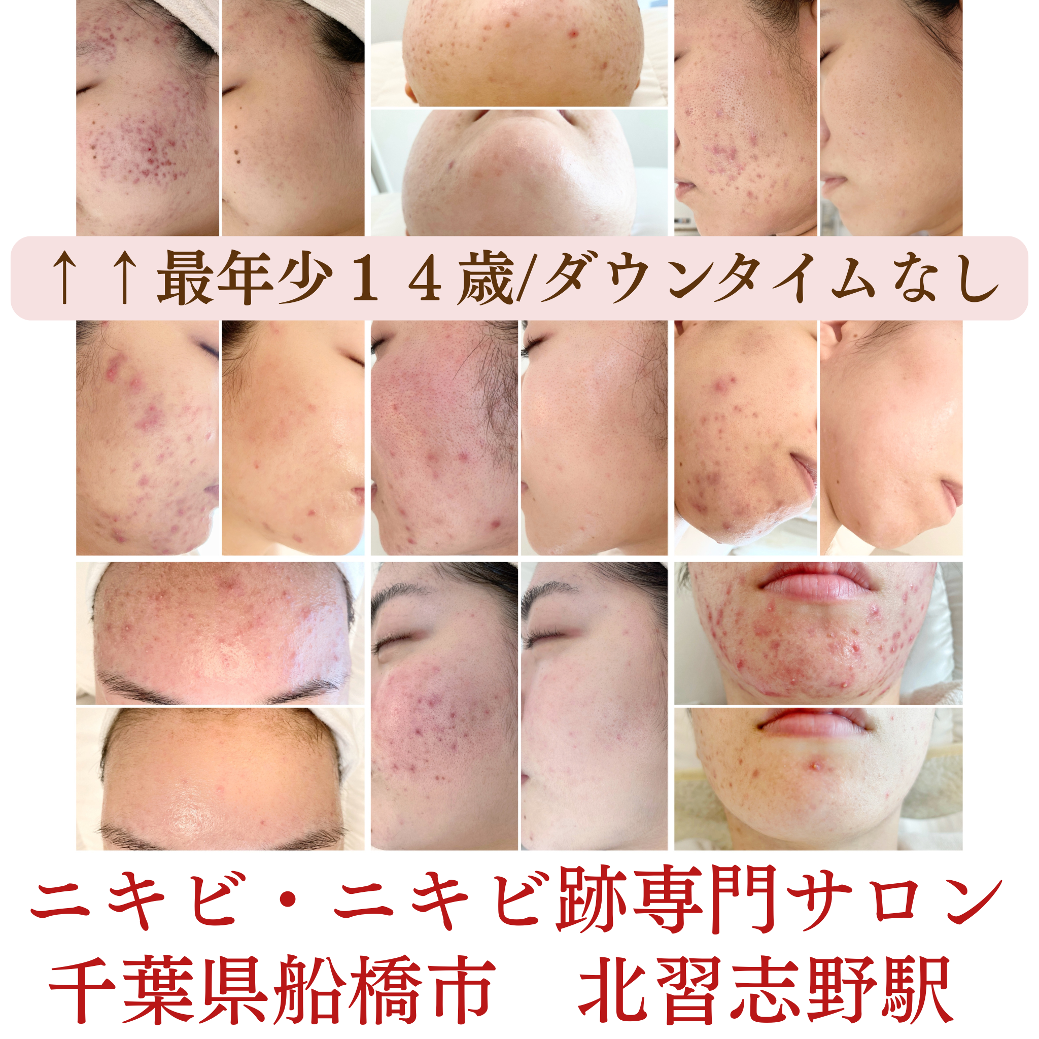 ニキビは一晩で治る？即効ケアとやってはいけないNG行動