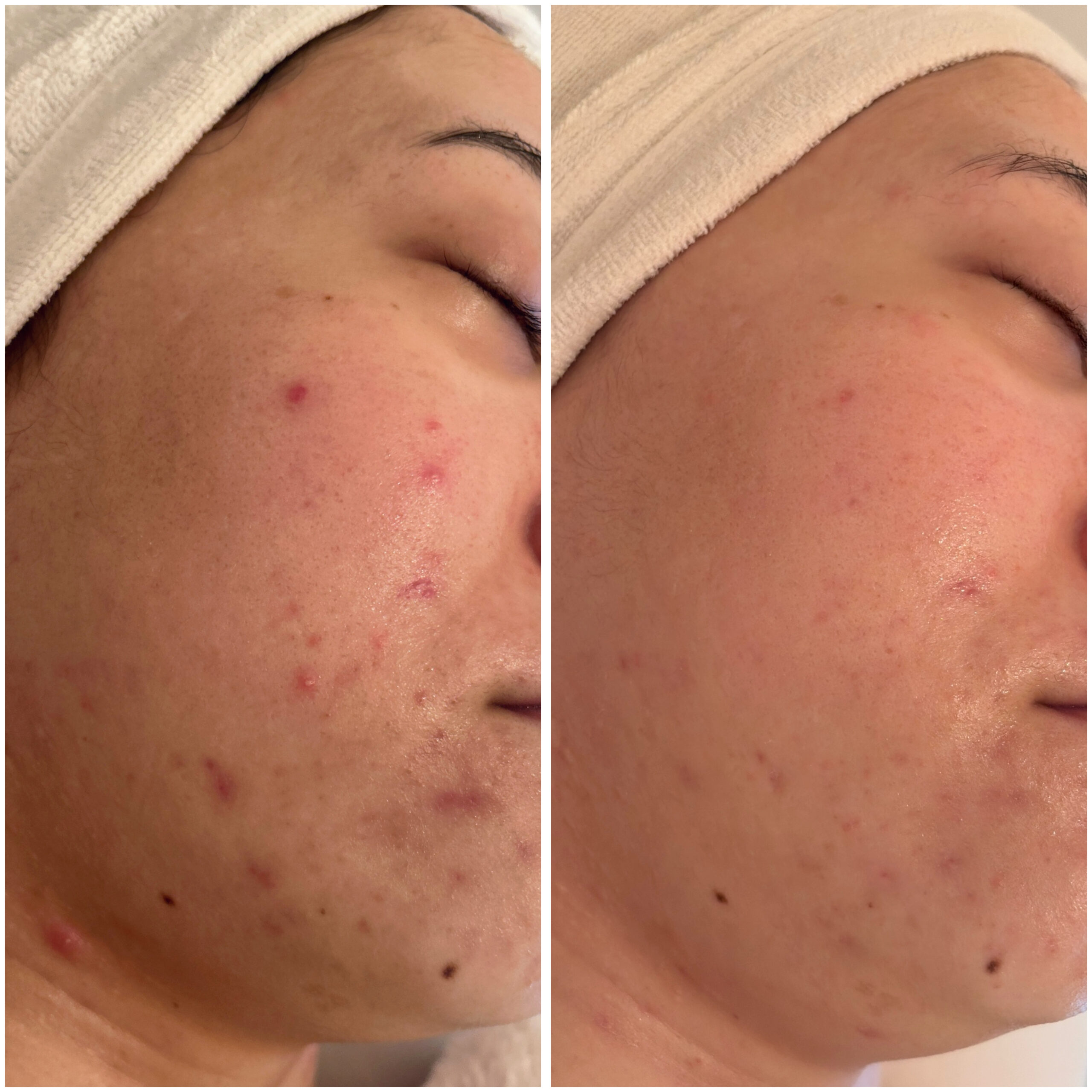 八千代市｜皮膚科でも治らないニキビ肌の悩み解決